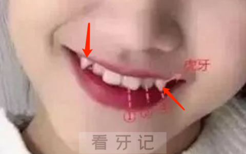 孩子“虎牙”长得不好看医生说不能拔虎牙是真的假的