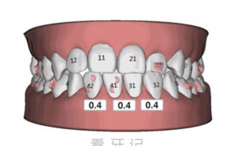 太可怕了？牙齿矫正会导致牙齿松动