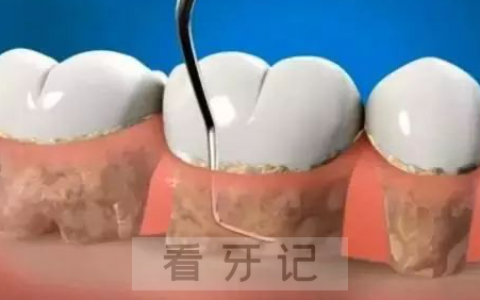 太可怕了洗牙要将牙龈翻开吗疼不疼