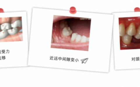 牙齿缺太久想种牙后悔都来不及了