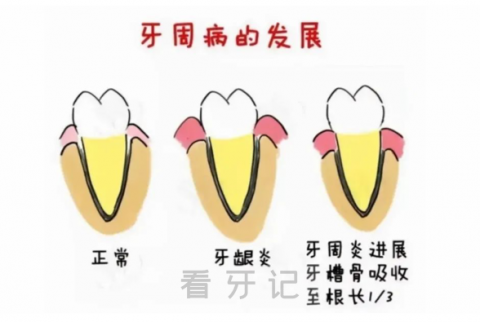 太可怕了牙根吸收对身体危害有多大