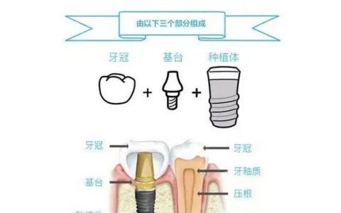 2023年衢州种植牙集采价格最新进度进展附国产进口价格