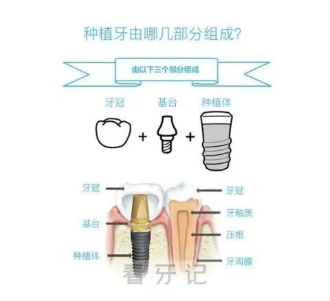 023年衢州种植牙集采价格最新进度进展附国产进口价格"