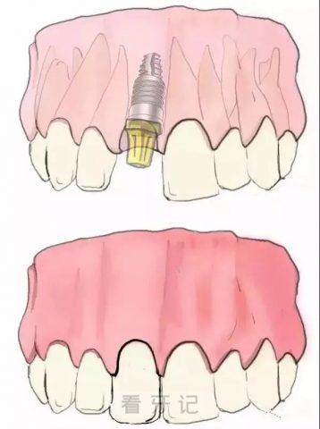 单颗种植牙手术步骤流程示意图2023版