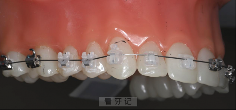 普通陶瓷托槽和陶瓷自锁托槽牙套哪个最好