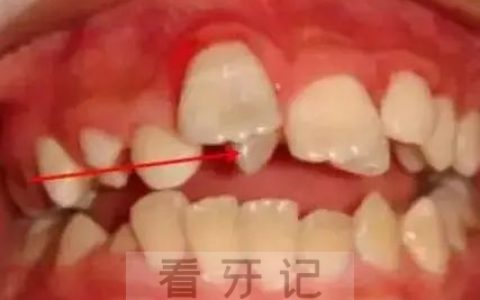 孩子长了多生牙医生说不用拔是不是真的