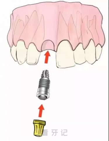 单颗种植牙手术步骤流程示意图2023版