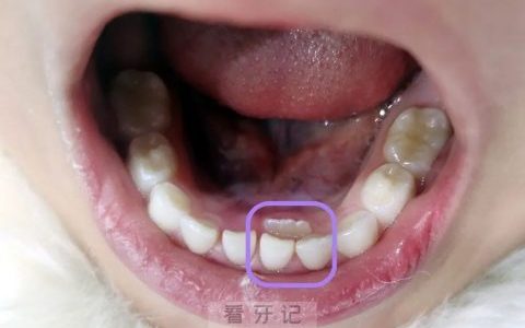双排牙长什么样附高清图片