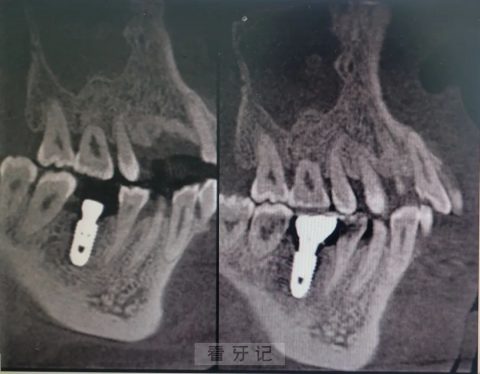 绍兴市中心医院口腔科看牙记