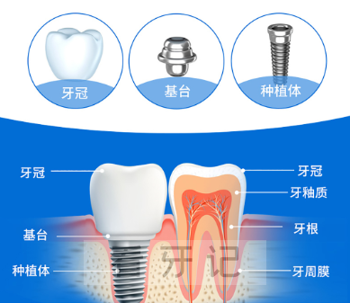 什么是种植牙（结构图解）