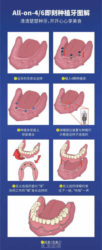 全口无牙颌缺失种植牙前后对比图及全口种牙流程图