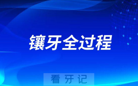 镶牙全过程六大步骤