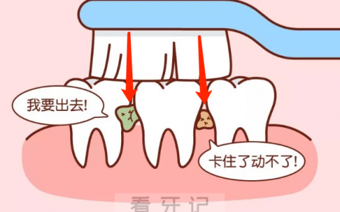 为什么天天刷牙还得邻面龋