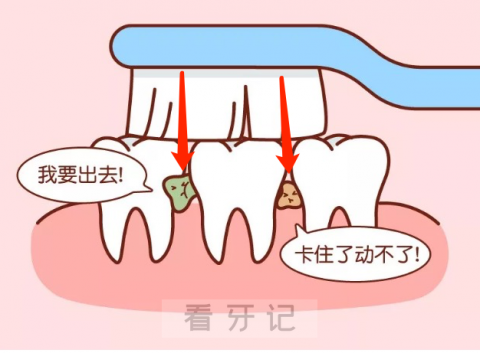 为什么天天刷牙还得邻面龋