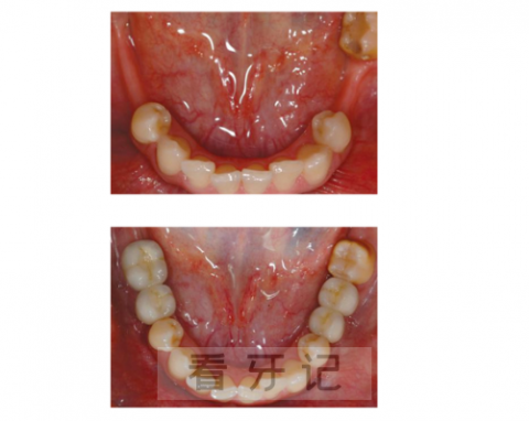 多颗缺失种植牙前后对比图