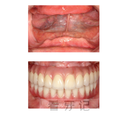 全口无牙颌缺失种植牙前后对比图及全口种牙流程图