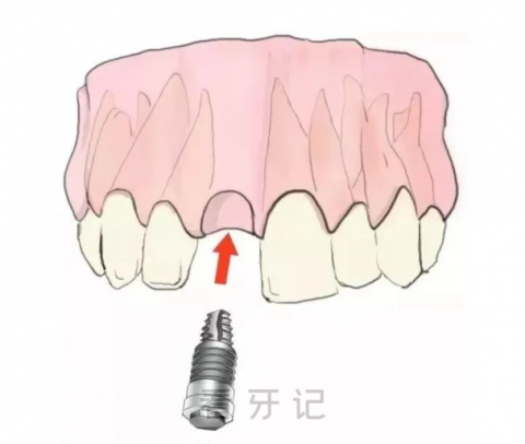 种植牙是什么种植牙好吗种植牙图片介绍