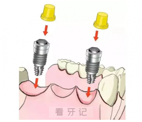 种植牙是什么种植牙好吗种植牙图片介绍