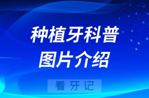 种植牙是什么种植牙好吗种植牙图片介绍