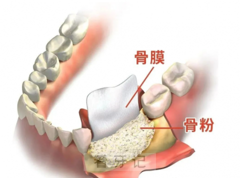 种植牙骨粉太贵了比黄金还贵