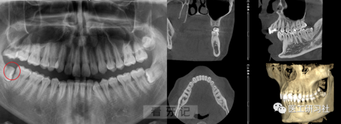 什么是种植牙CBCT