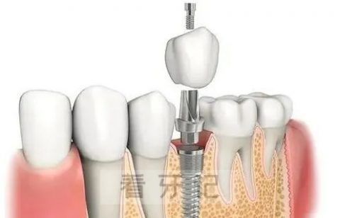 种植牙是什么意思和原理