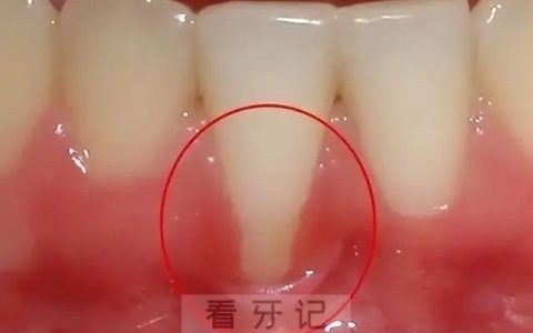 牙龈萎缩真实图片