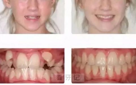 小时候瓜子脸长大可能变成大龅牙