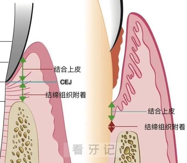 关于种植牙的结构和种牙过程看这张图片就够了