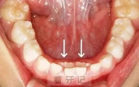 双排牙到底要不要拔除看看医生怎么说