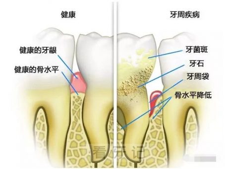 牙周炎拖到最后竟然是这样结果太可怕了附图片