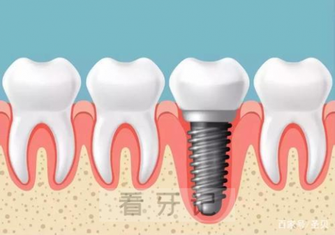 种植牙刷牙要注意什么怎么刷牙更科学合理