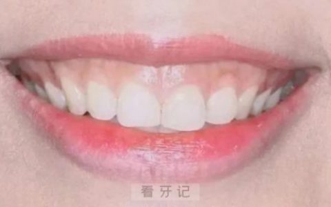 什么是露龈笑附真实图片