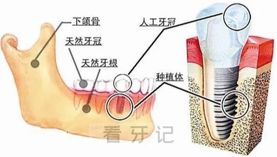 关于种植牙的结构和种牙过程看这张图片就够了