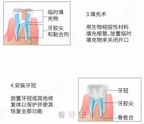 根管治疗看牙记含治疗价格明细（第五次去医院）