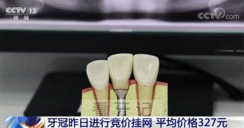 全国种植牙集采最新进展2023牙冠竞价挂网价格出炉
