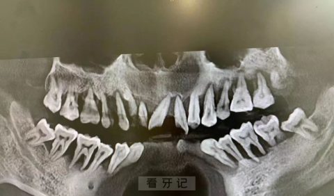 牙周炎拖到最后竟然是这样结果太可怕了附图片