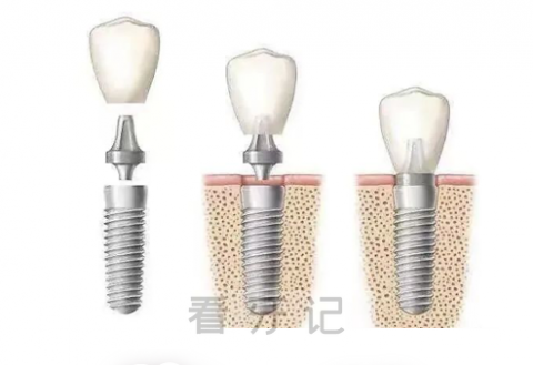 太神奇了种植牙是怎么“种”出来的