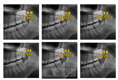 口腔医院拔智齿价格价目表2023年版