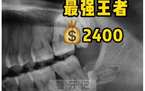 口腔医院拔智齿价格价目表2023年版