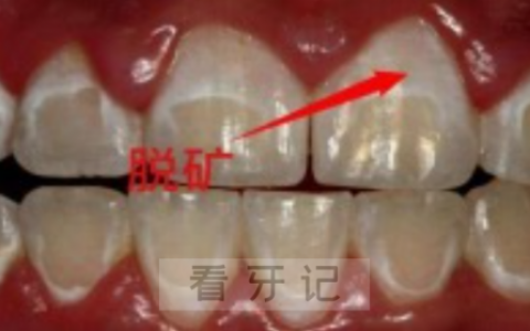 牙齿出现白色斑点怎么办是什么征兆