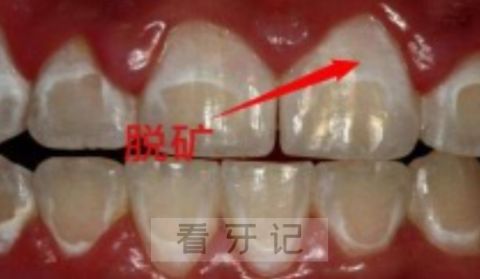 牙齿出现白色斑点怎么办是什么征兆