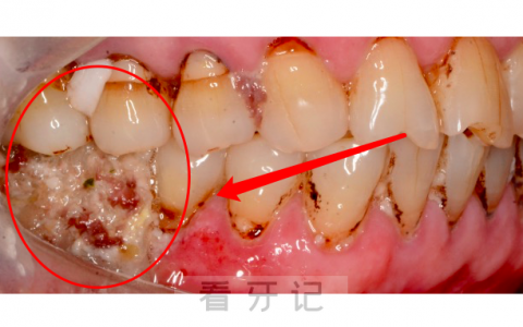 都是智商税！网购补牙材料竟然把自己送进了医院