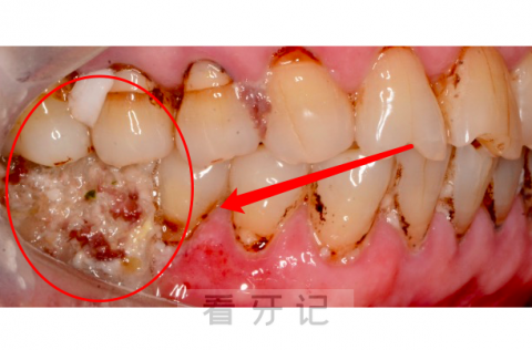 都是智商税！网购补牙材料竟然把自己送进了医院