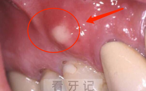 牙龈上长了个小鼓包为何医生让我拔牙