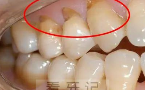 想要牙齿干净就得使劲刷牙
