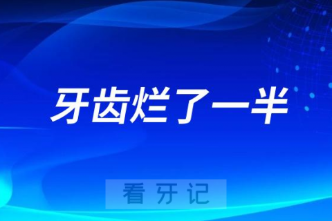 没去看牙后悔死了牙齿烂了一半竟然不能补牙了