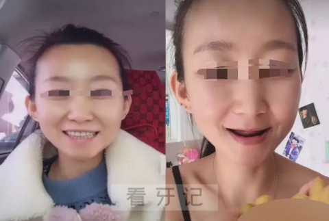 牙周炎太可怕了美女被牙周炎折磨被迫拔光满嘴牙齿