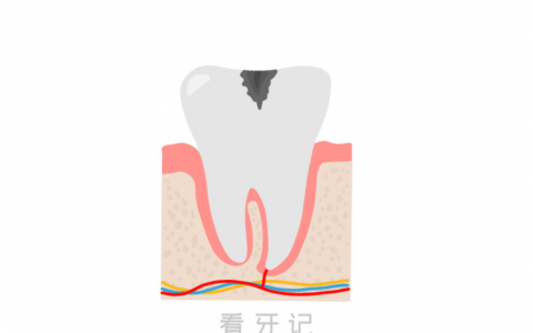 让人瑟瑟发抖的龋齿到底是怎么形成的