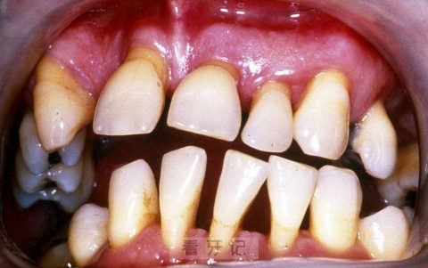 最可怕的牙齿问题是牙龈萎缩附图片